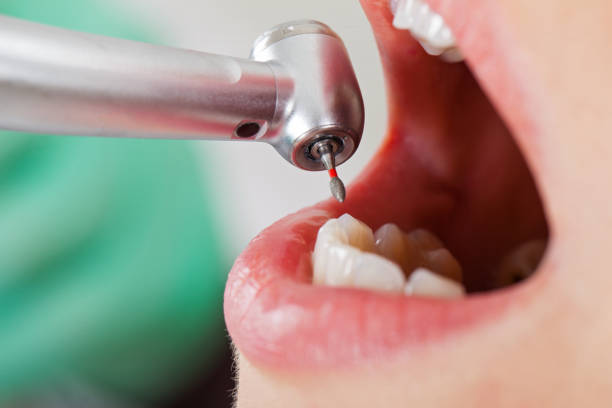 Best Emergency Dentist for Knocked-Out Tooth in University Park, MD